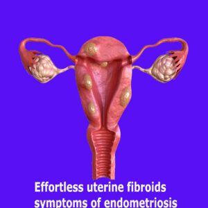 Effortless uterine fibroids symptoms of endometriosis