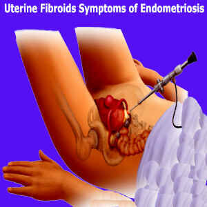 Effortless uterine fibroids symptoms of endometriosis