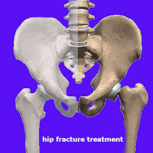 Wonderful hip fracture treatment without surgery the elderly