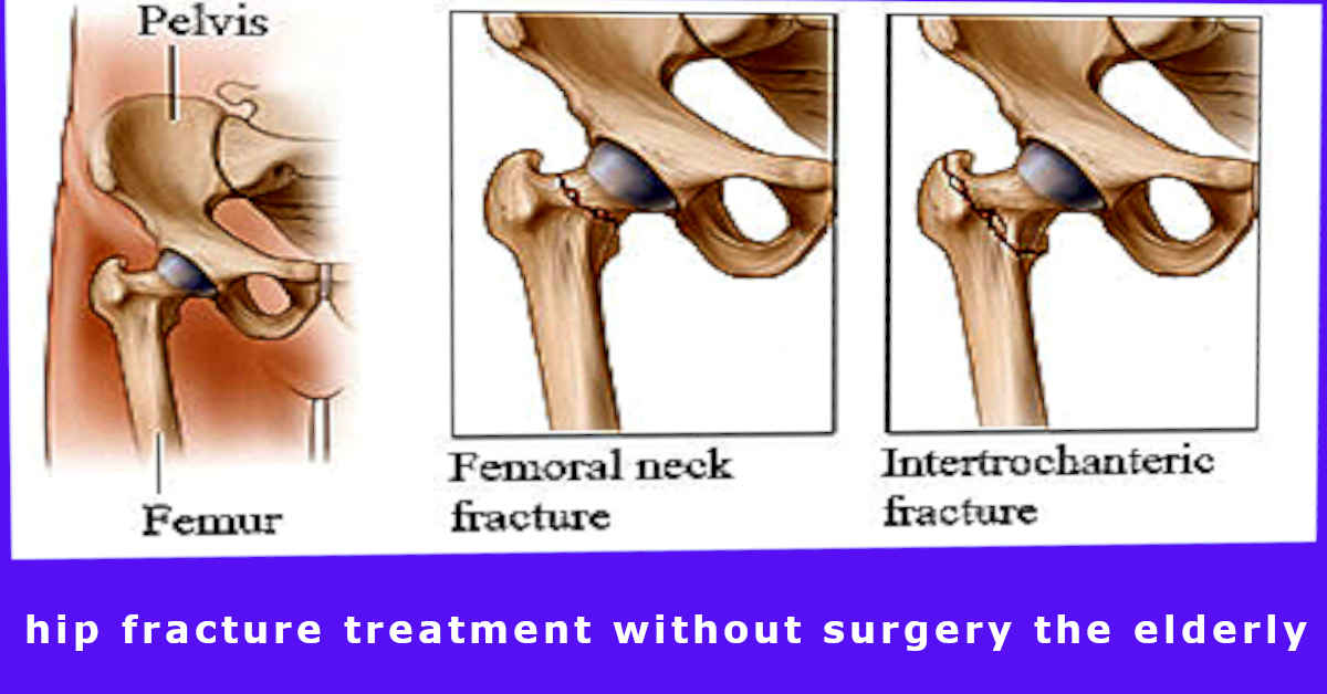 hip fracture treatment without surgery the elderly