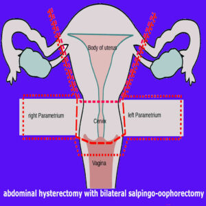 abdominal hysterectomy with bilateral salpingo-oophorectomy