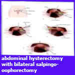 abdominal hysterectomy with bilateral salpingo-oophorectomy